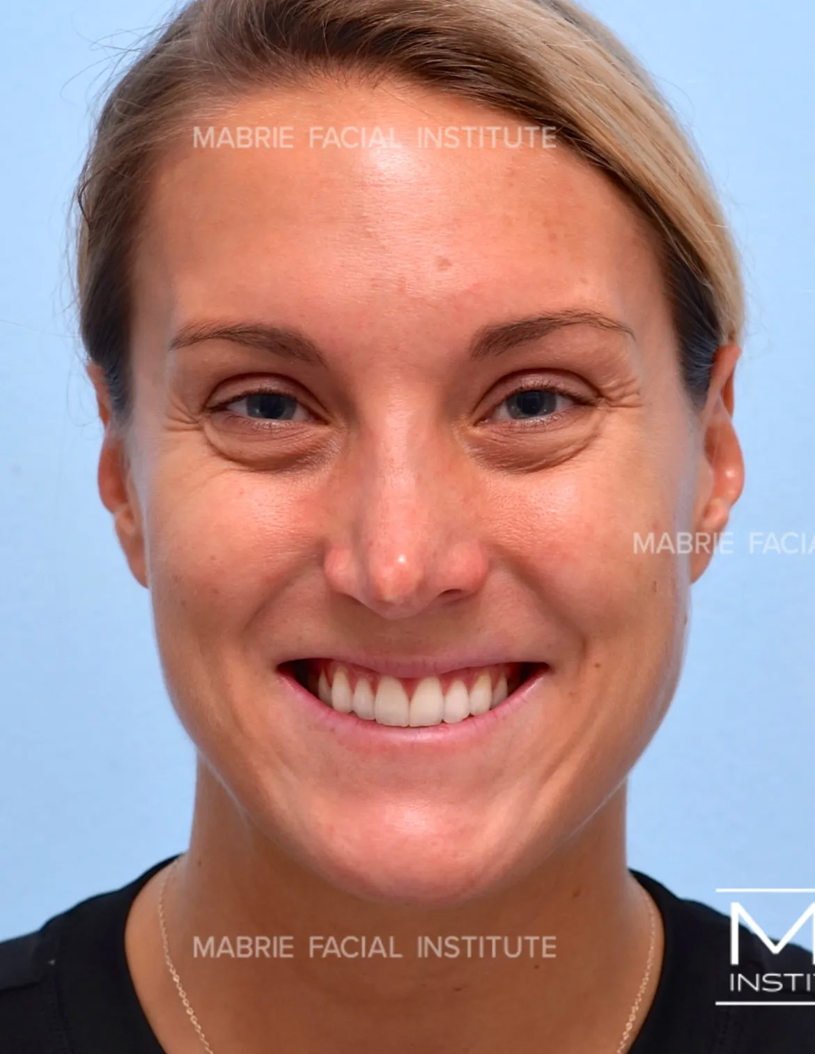 woman before crows feet botox treatment