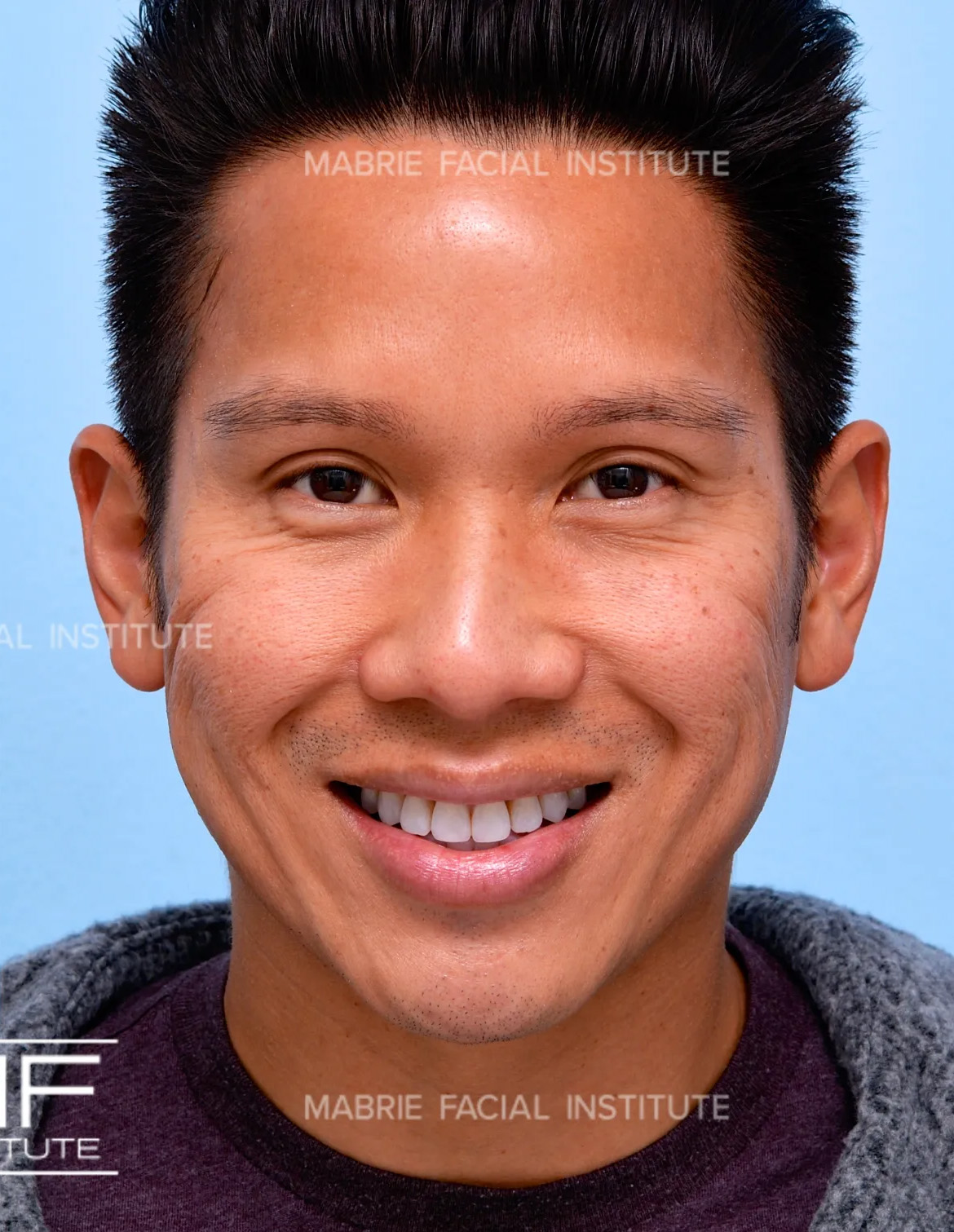 male after crows feet botox treatment
