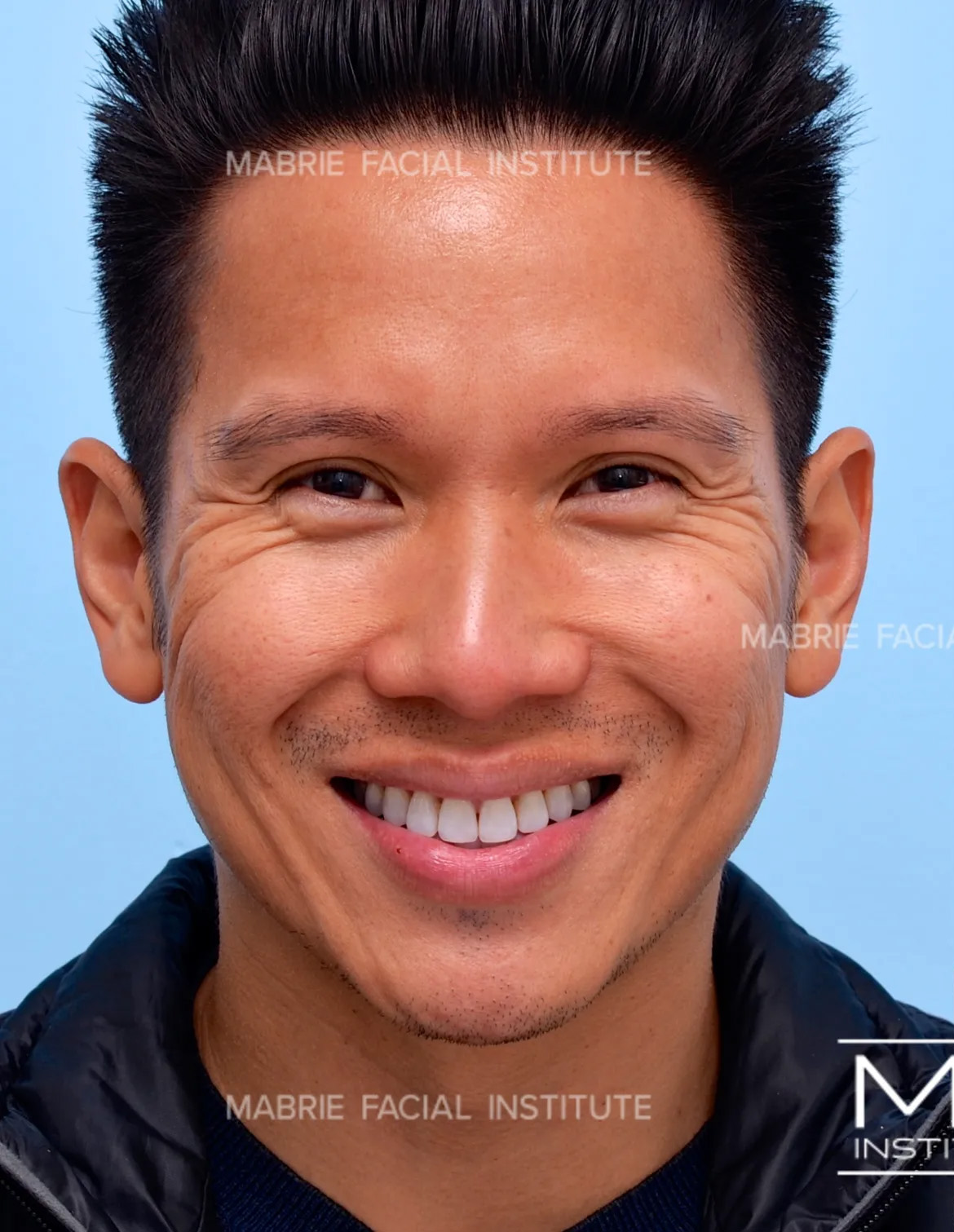 male before crows feet botox treatment