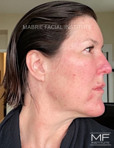 2 days after treatment