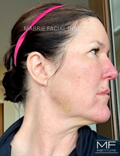 3 days after treatment