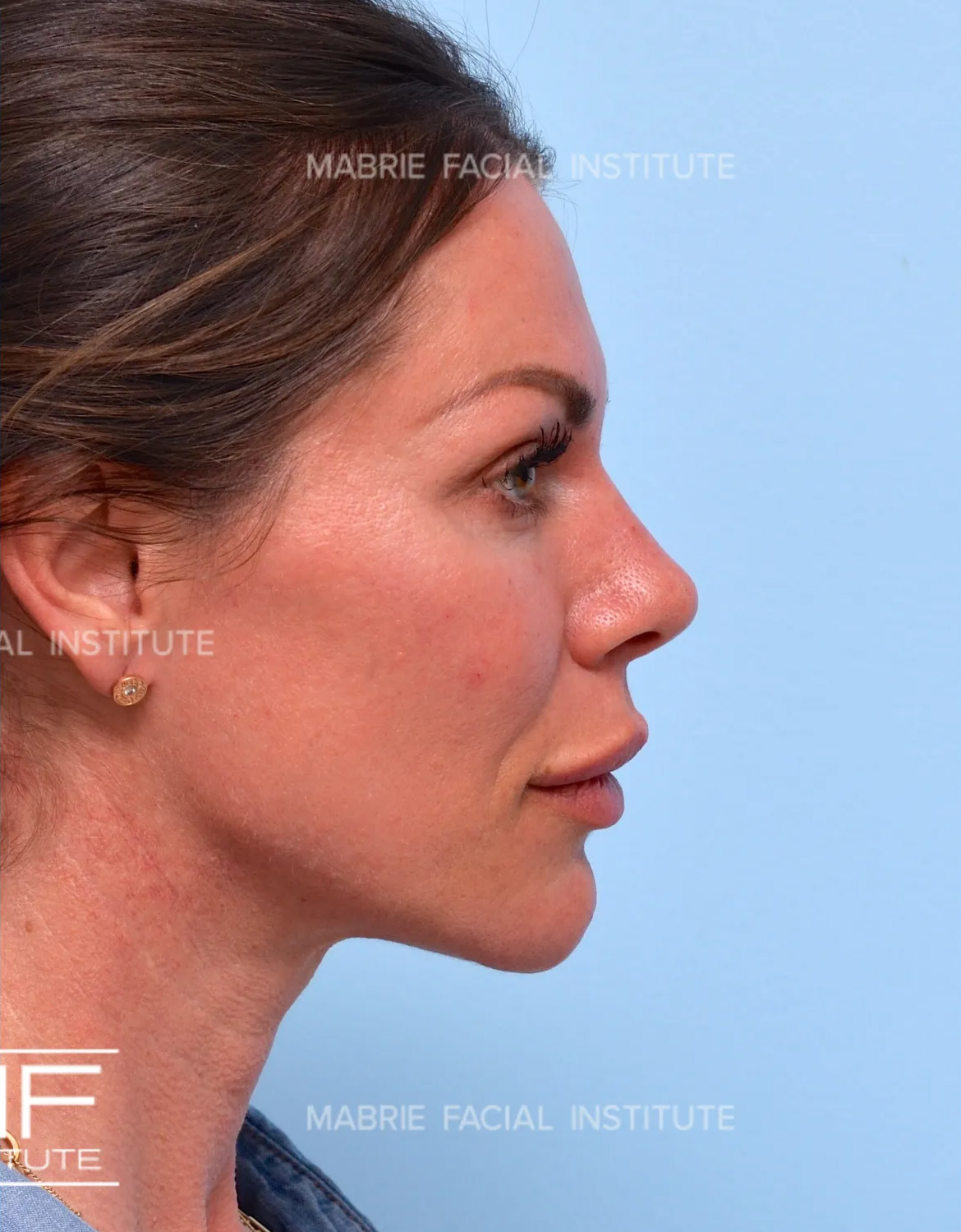 woman after chin fillers
