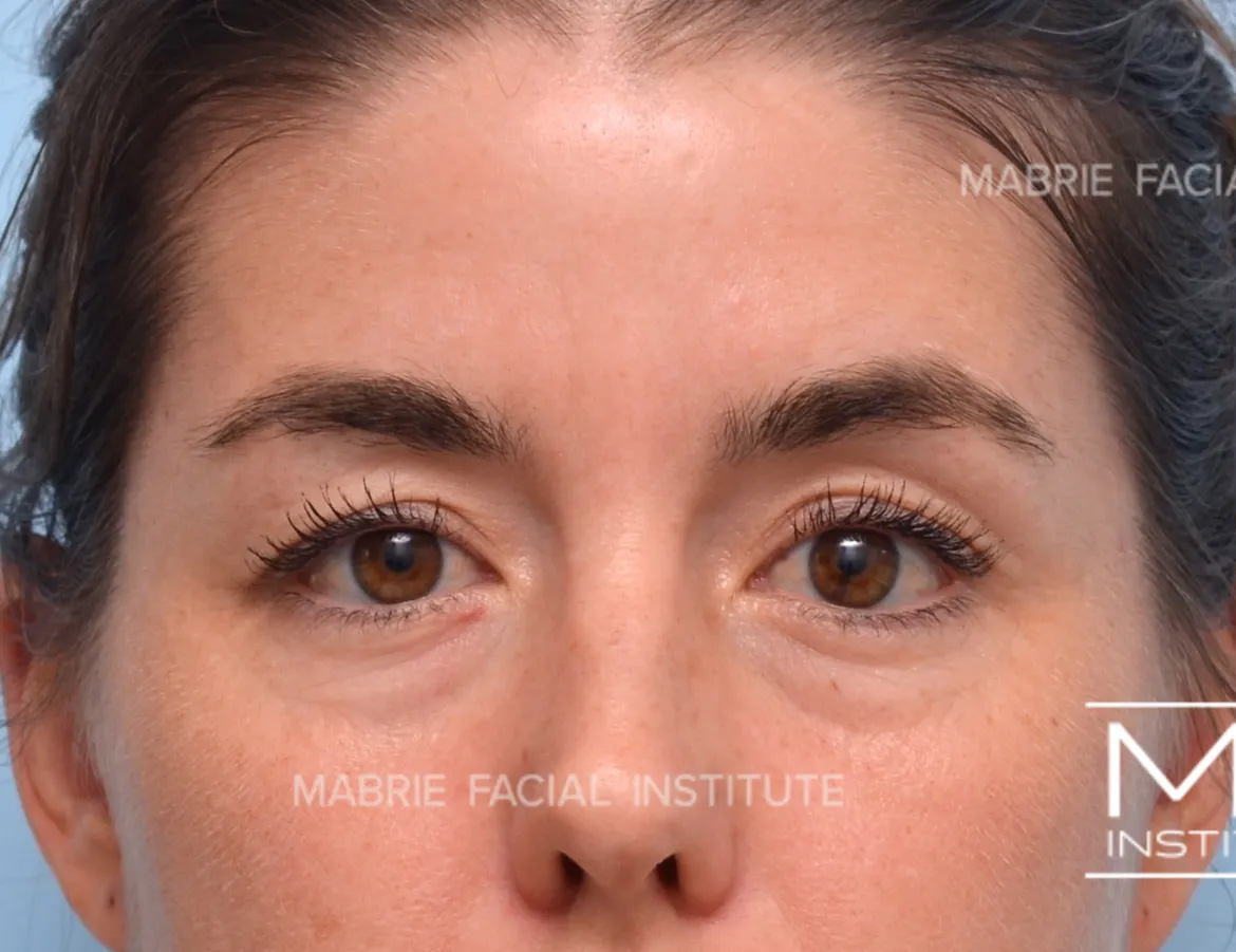woman before brow botox treatment