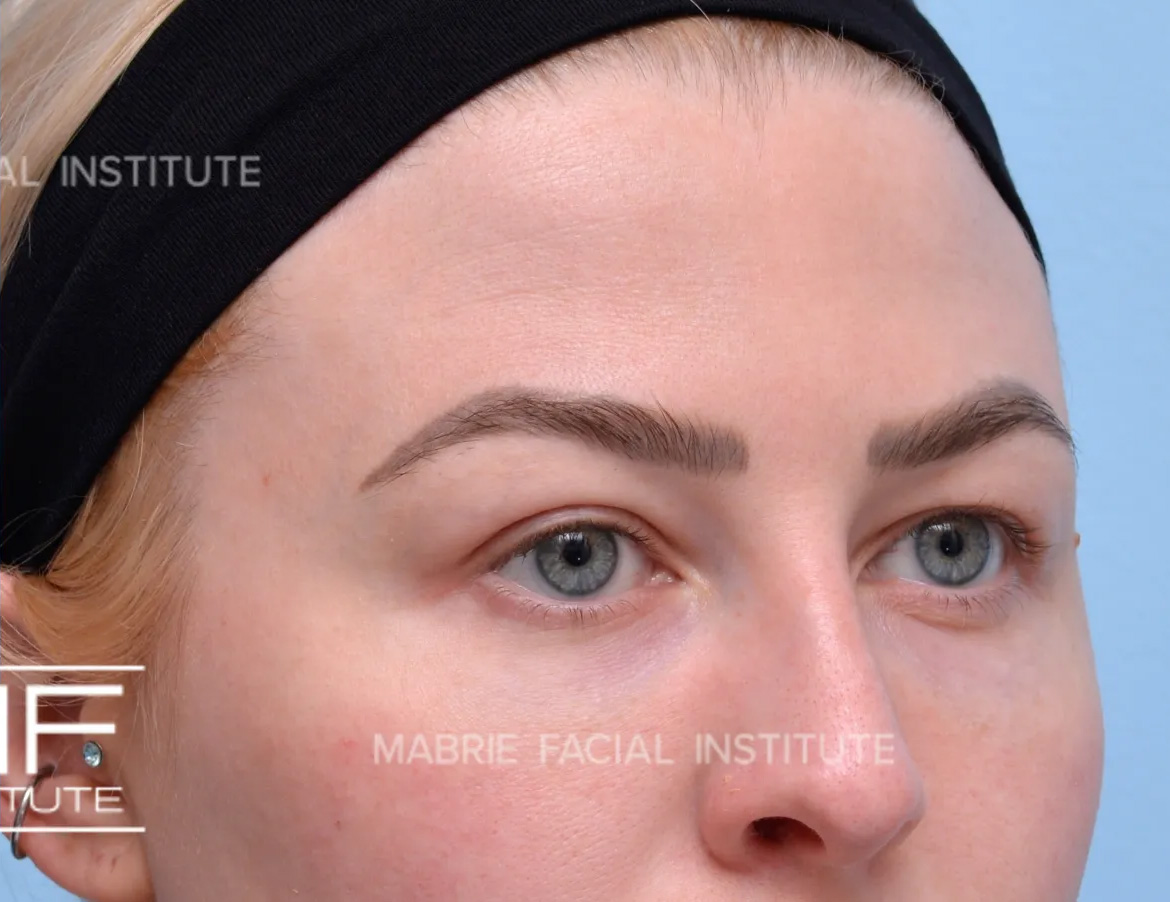 woman after brow botox
