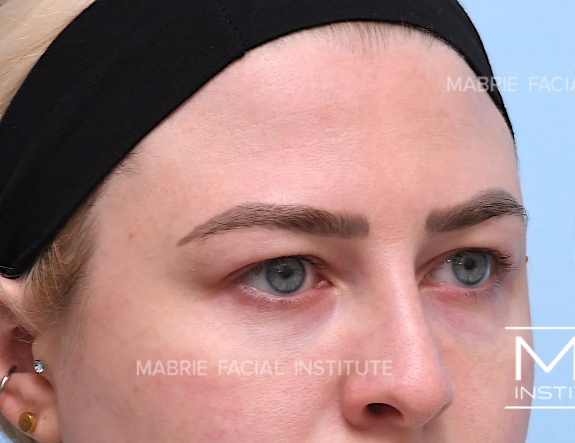 woman before brow botox