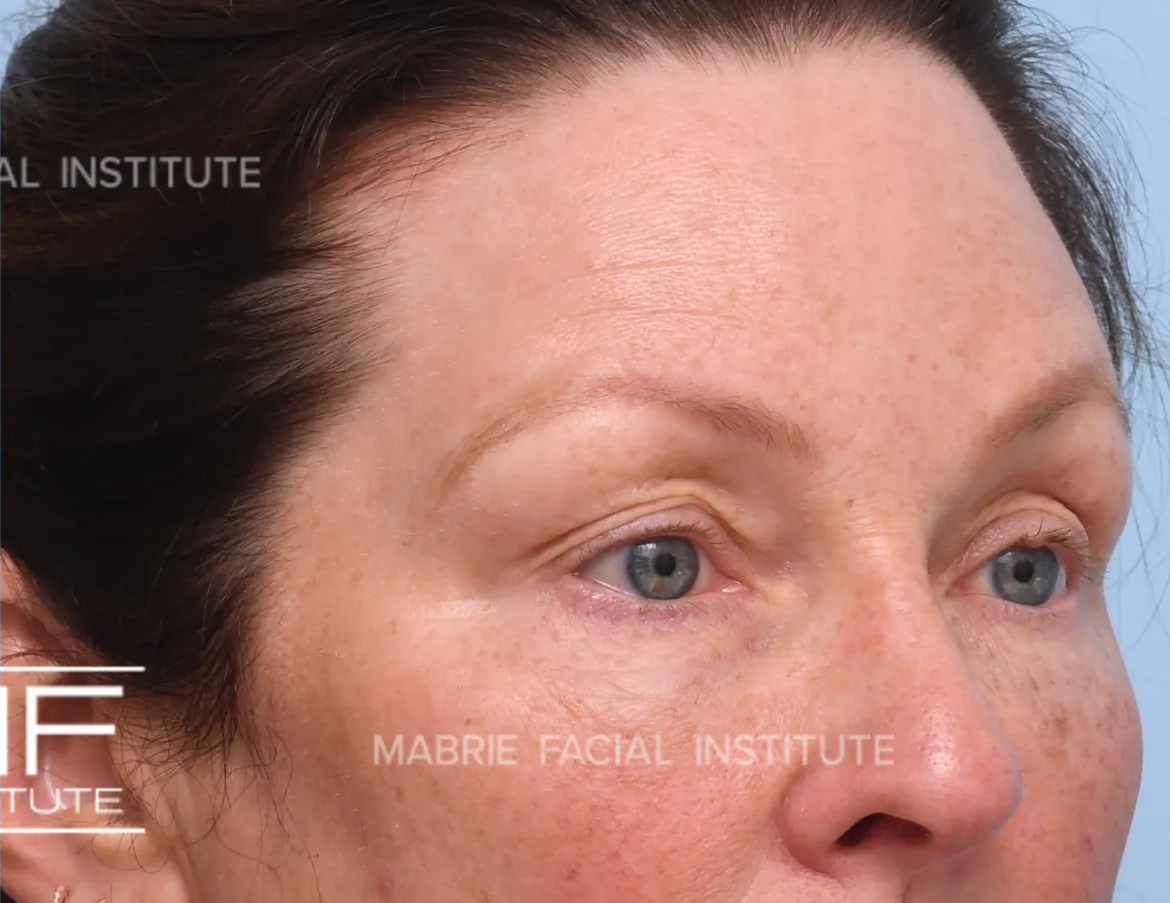 woman after brow botox