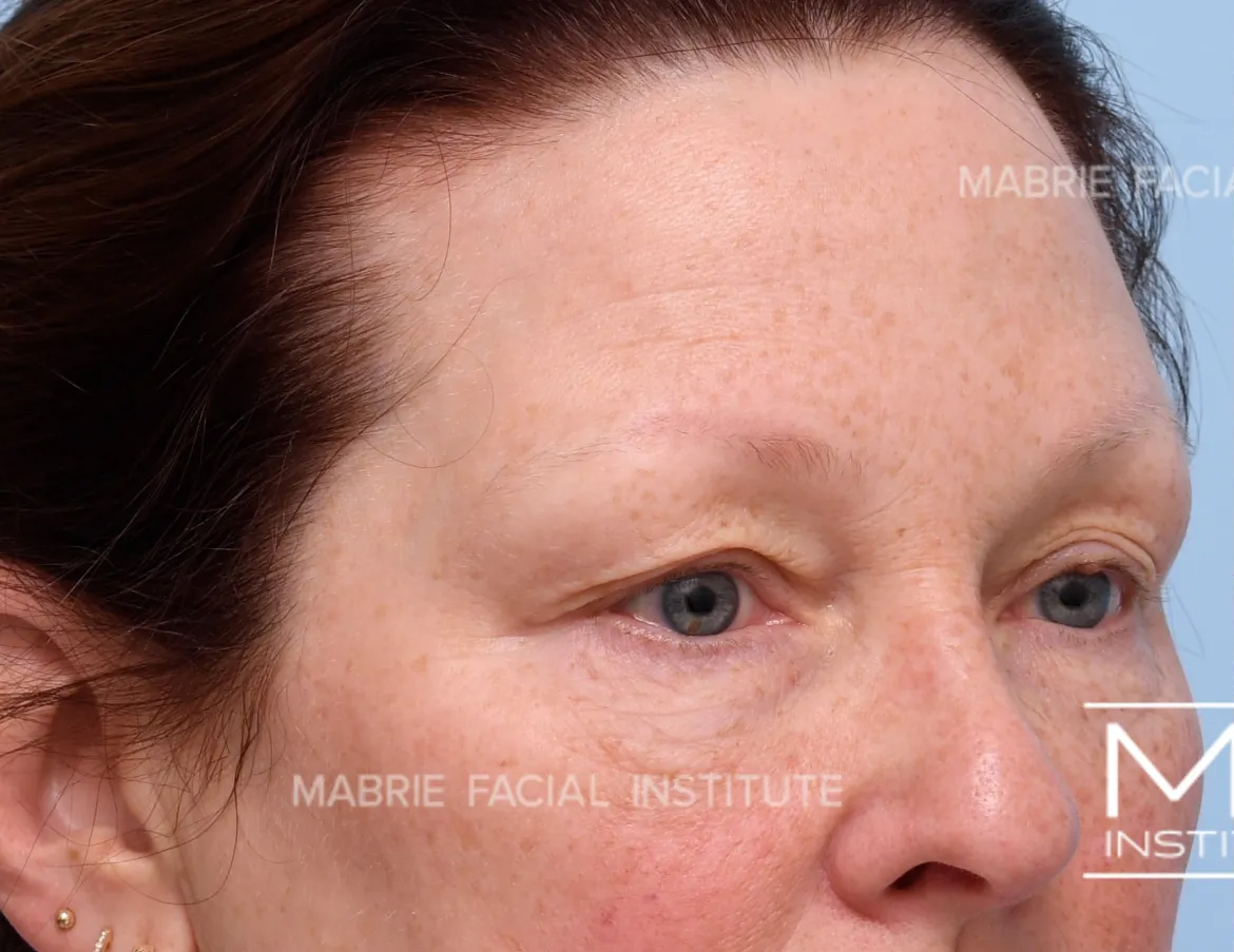 woman before brow botox