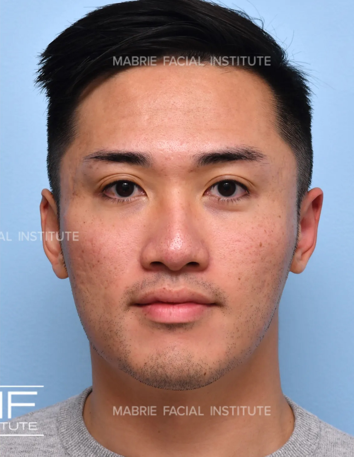 Man after face slimming with BOTOX.