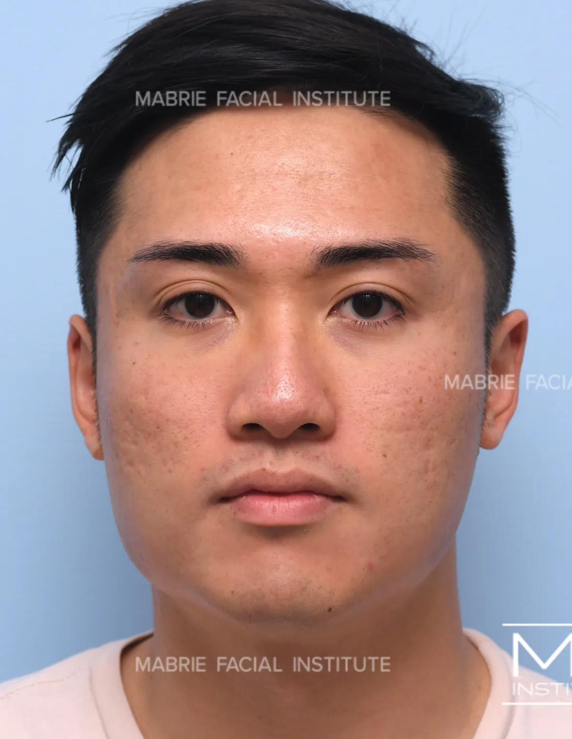 Man before face slimming with BOTOX.