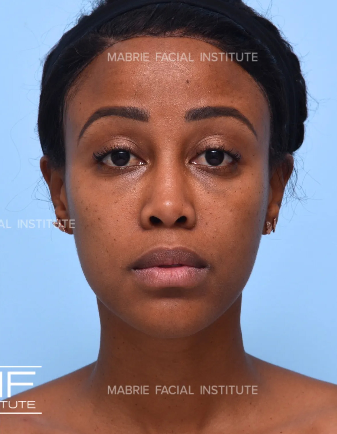 Woman after masseter botox treatment.