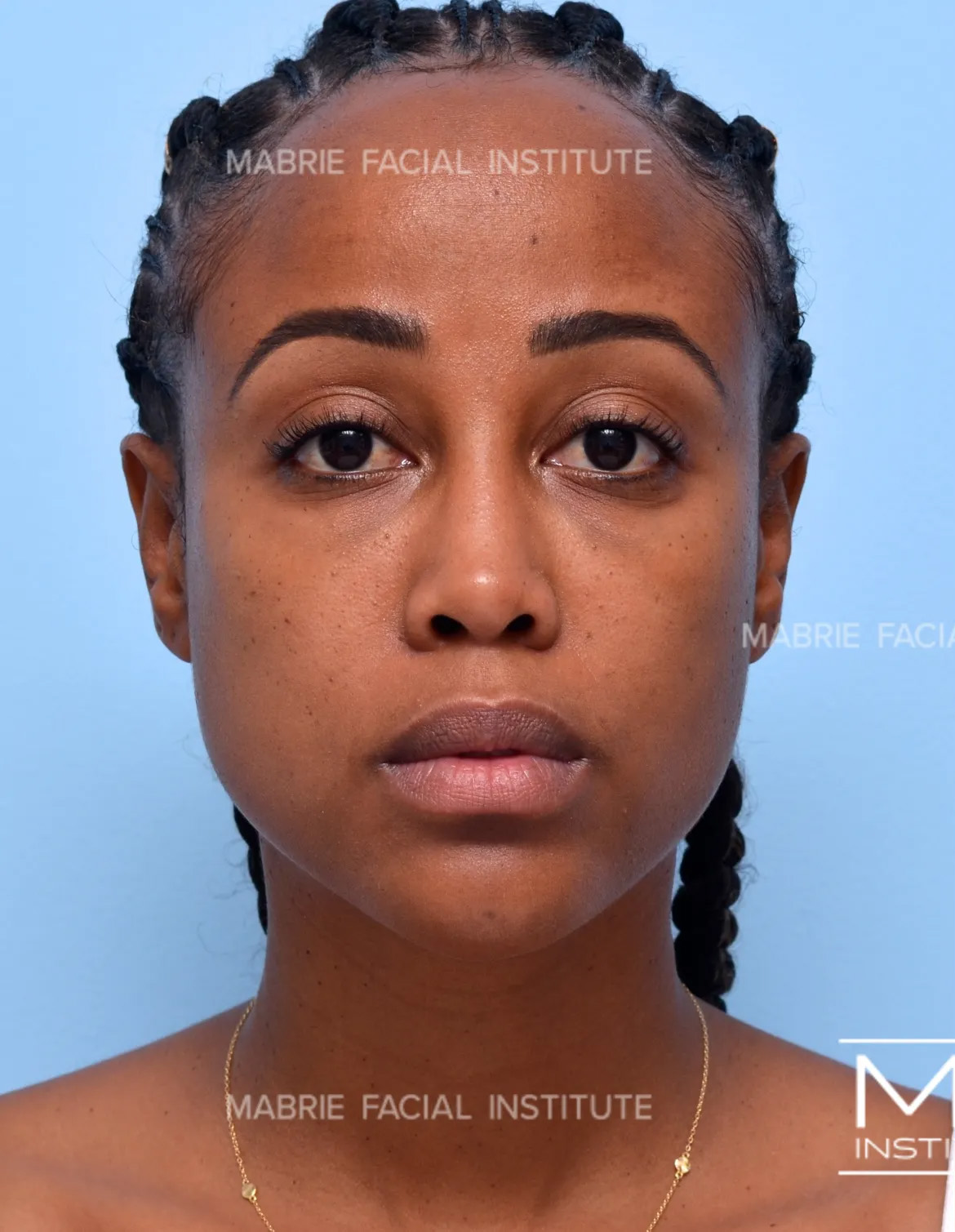 Woman before masseter botox treatment.