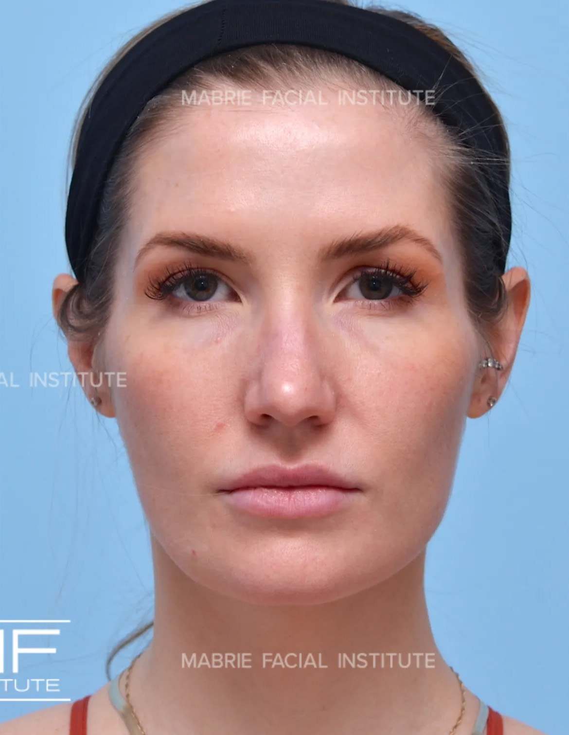 Woman after masseter botox treatment.