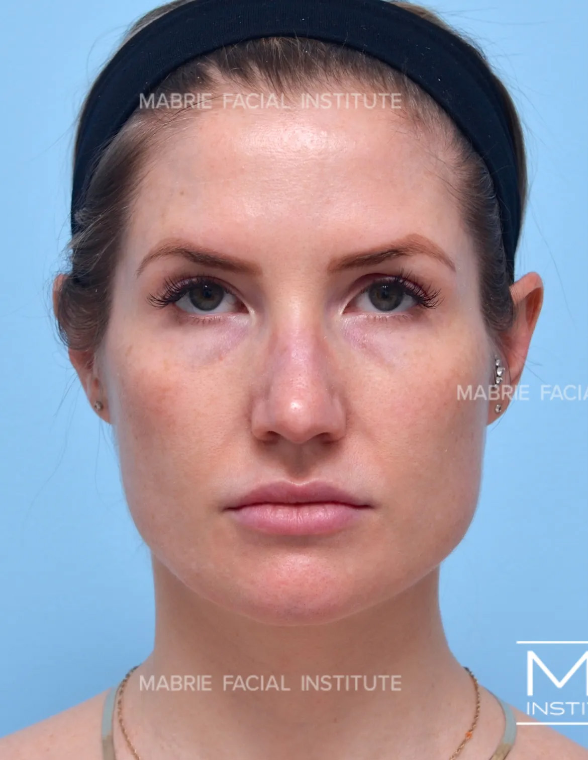 Woman before masseter botox treatment.