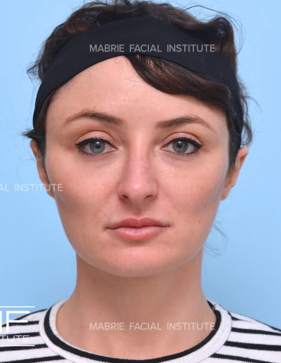 Woman after masseter botox treatment.