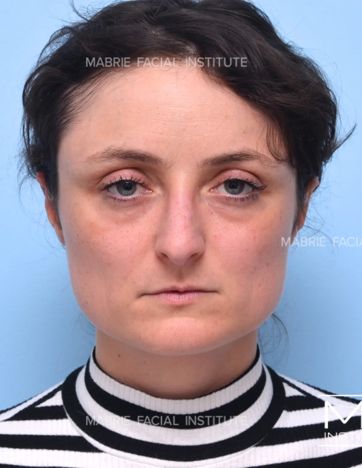 Woman before masseter botox treatment.