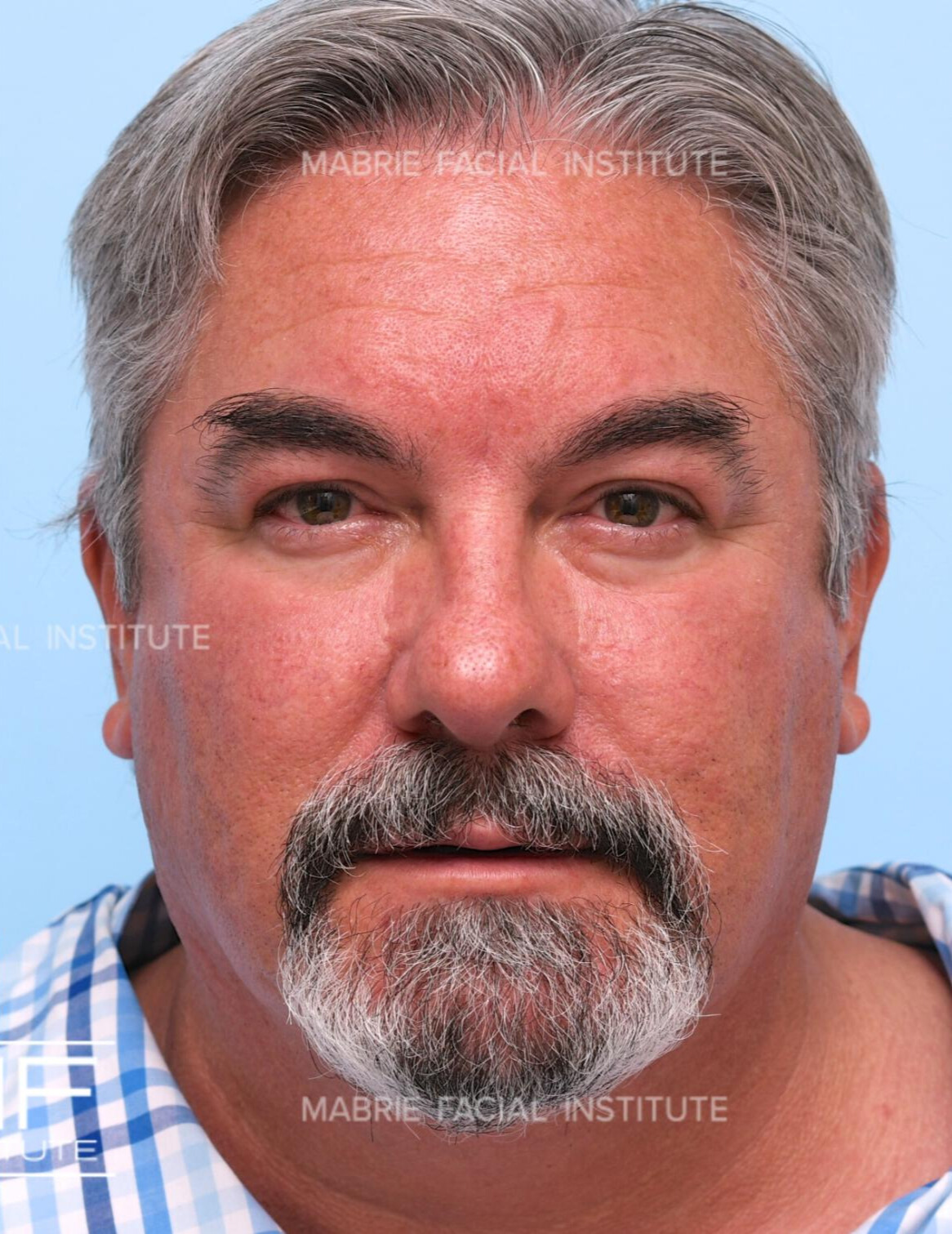 4 Weeks After Second BOTOX Treatment