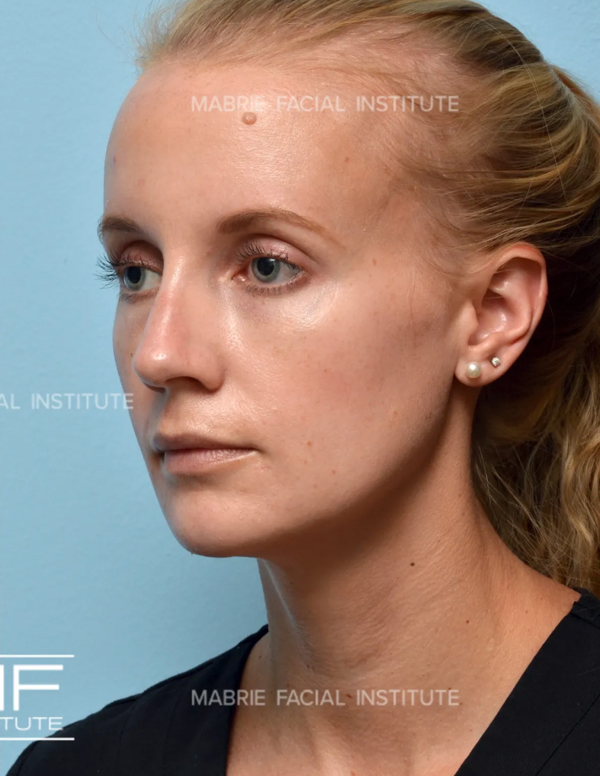 Woman after jawline filler treatment
