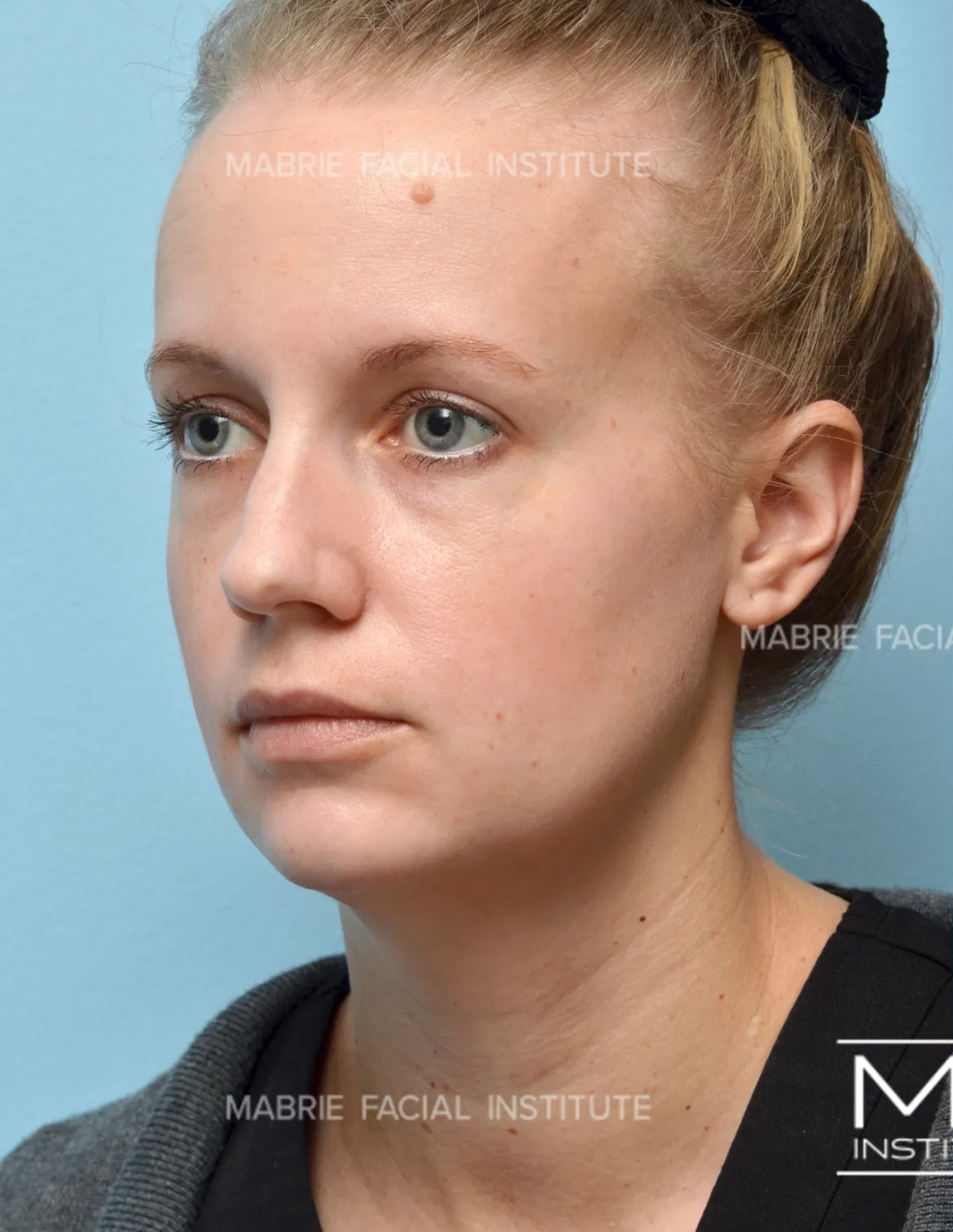 Woman before jawline filler treatment