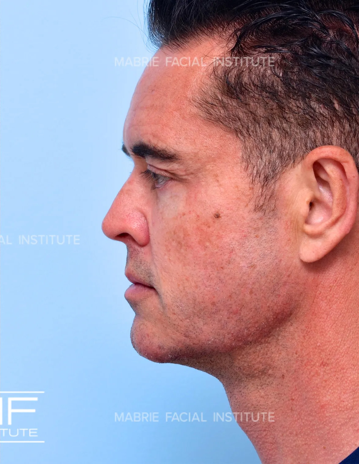 Male after jawline filler treatment