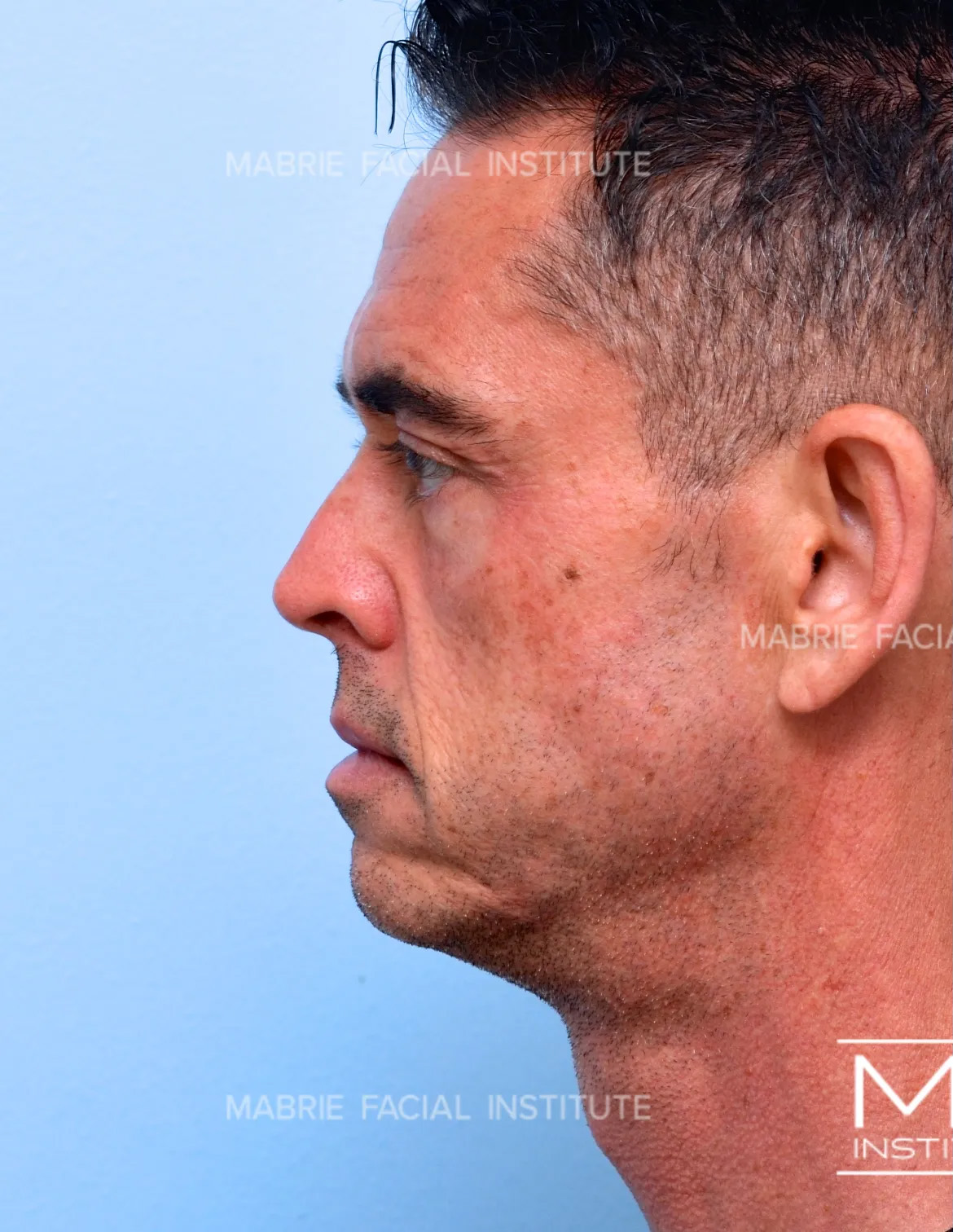 Male before jawline filler treatment