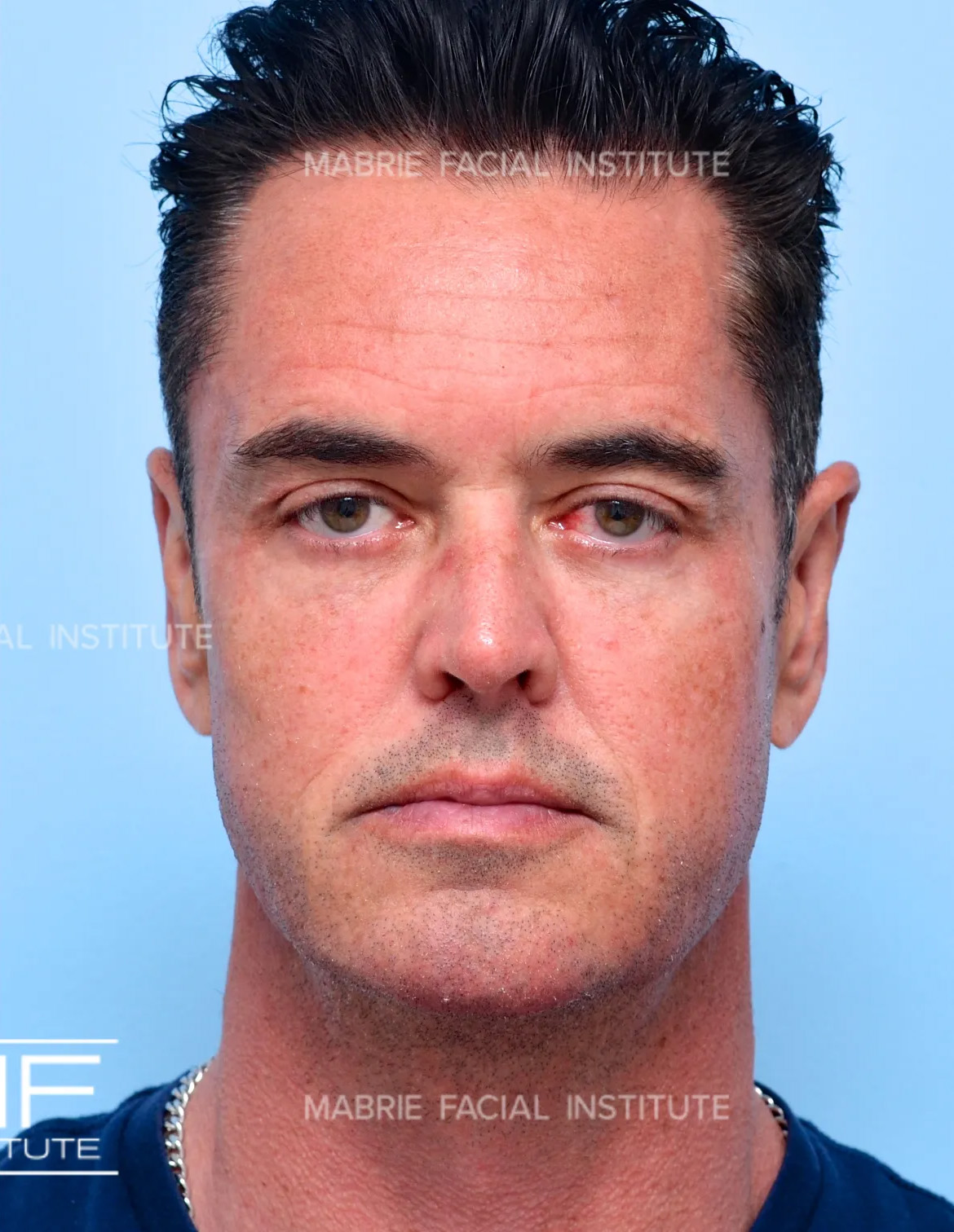 Man after the Complete Chin and Jawline Filler Package.