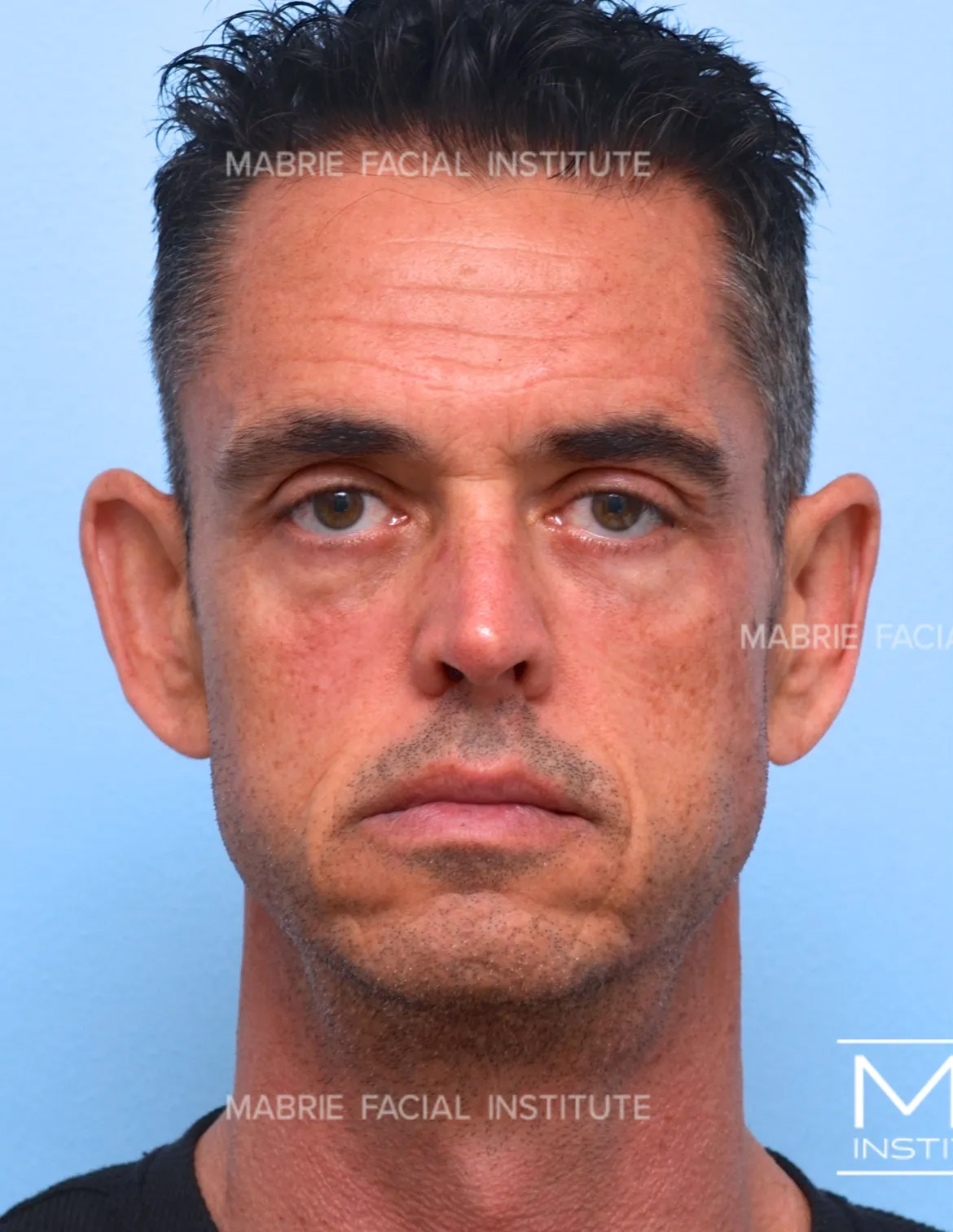 Man before the Complete Chin and Jawline Filler Package.