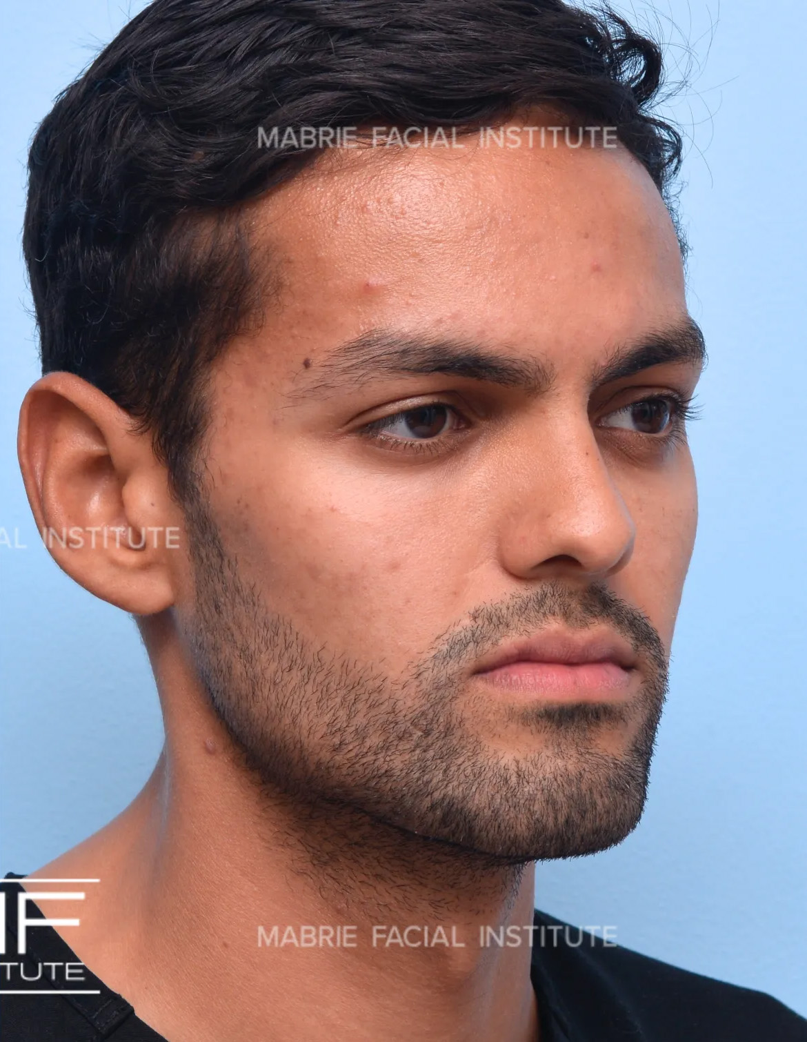 Male after jawline filler treatment.