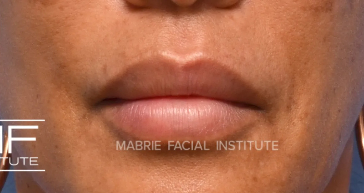 lips after lip filler