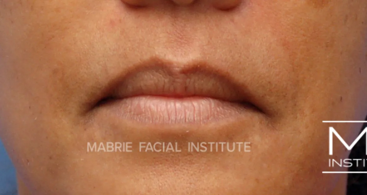 lips before lip filler