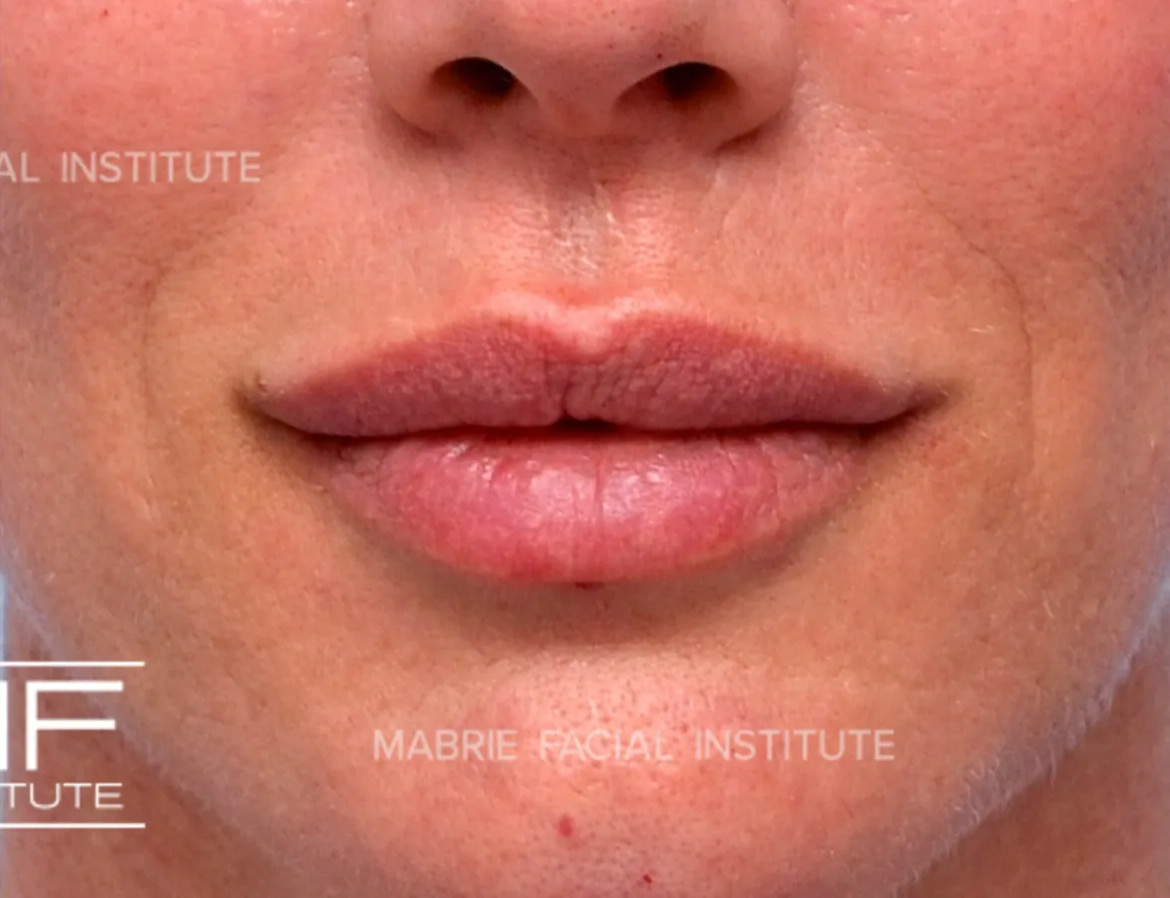 woman after lip filler