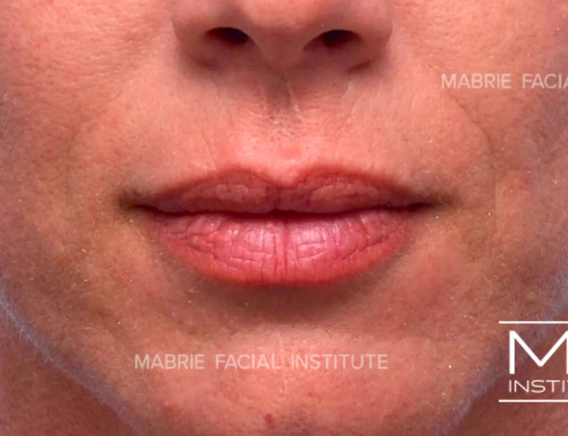 woman before lip filler