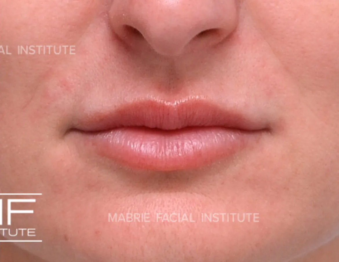 lips after lip filler