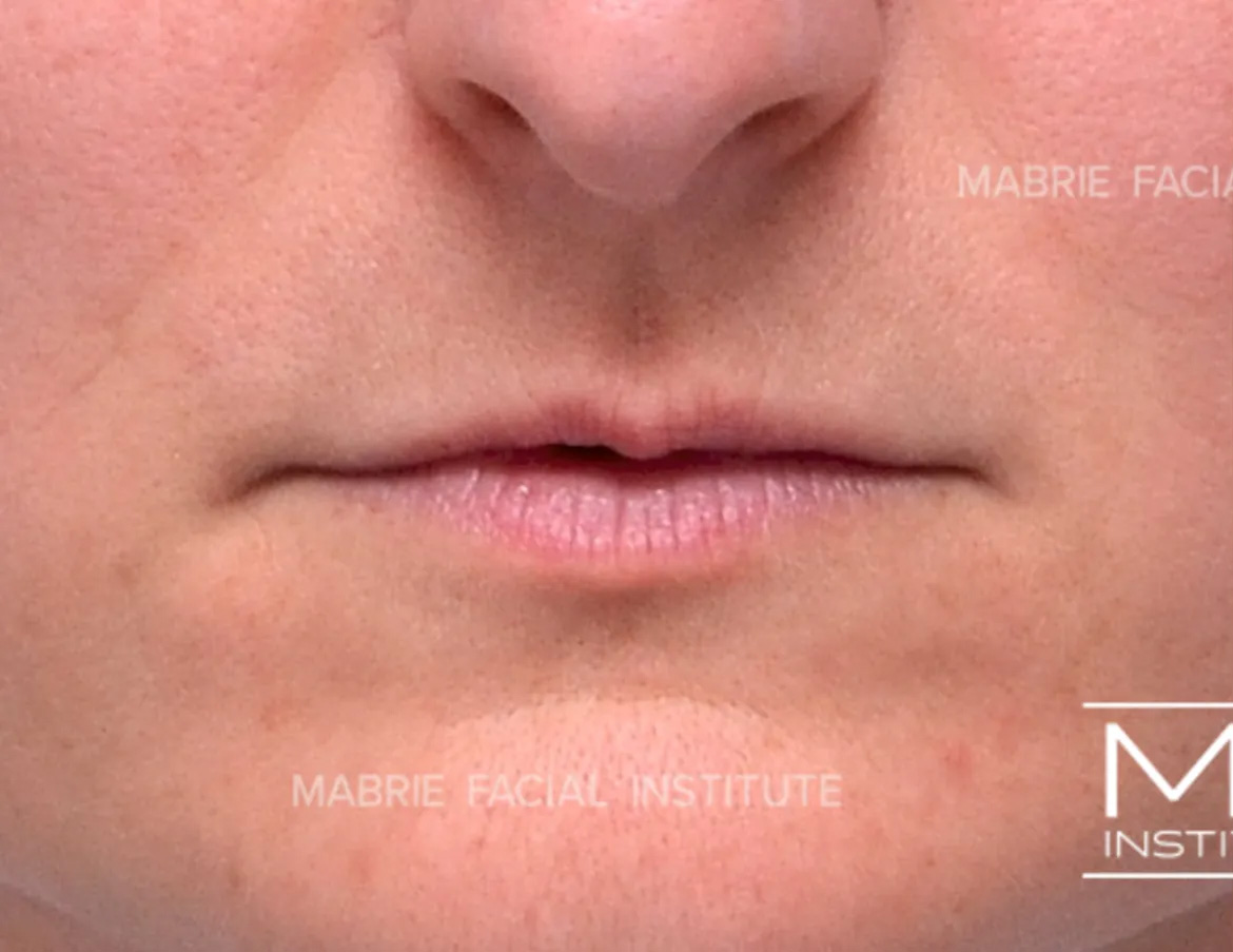 lips before lip filler