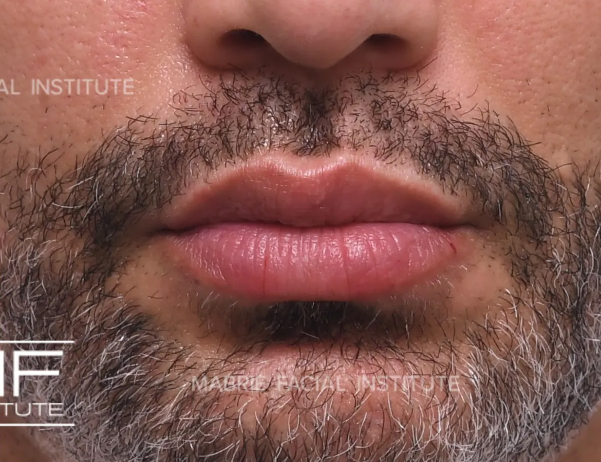 lips after lip filler