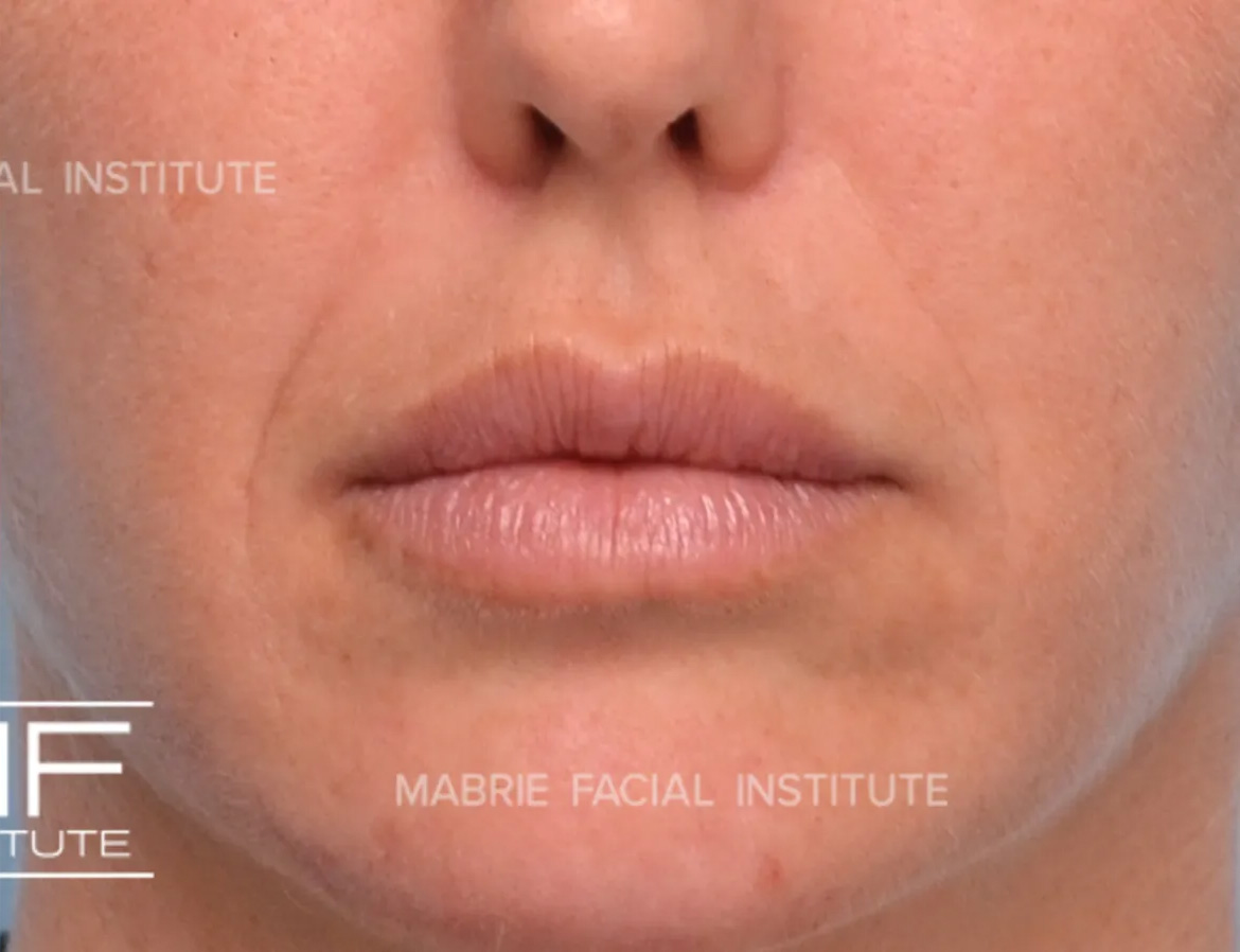 woman after subtle lip filler