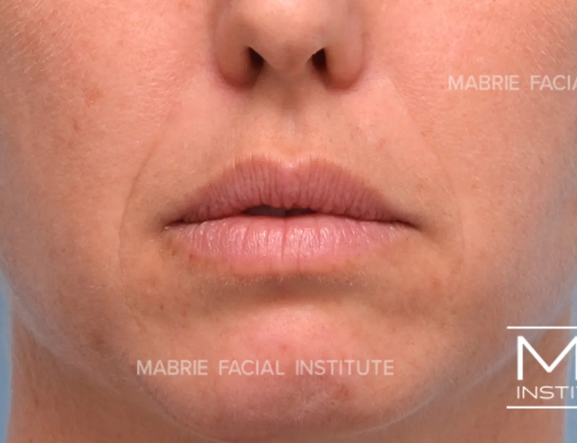 woman before subtle lip filler