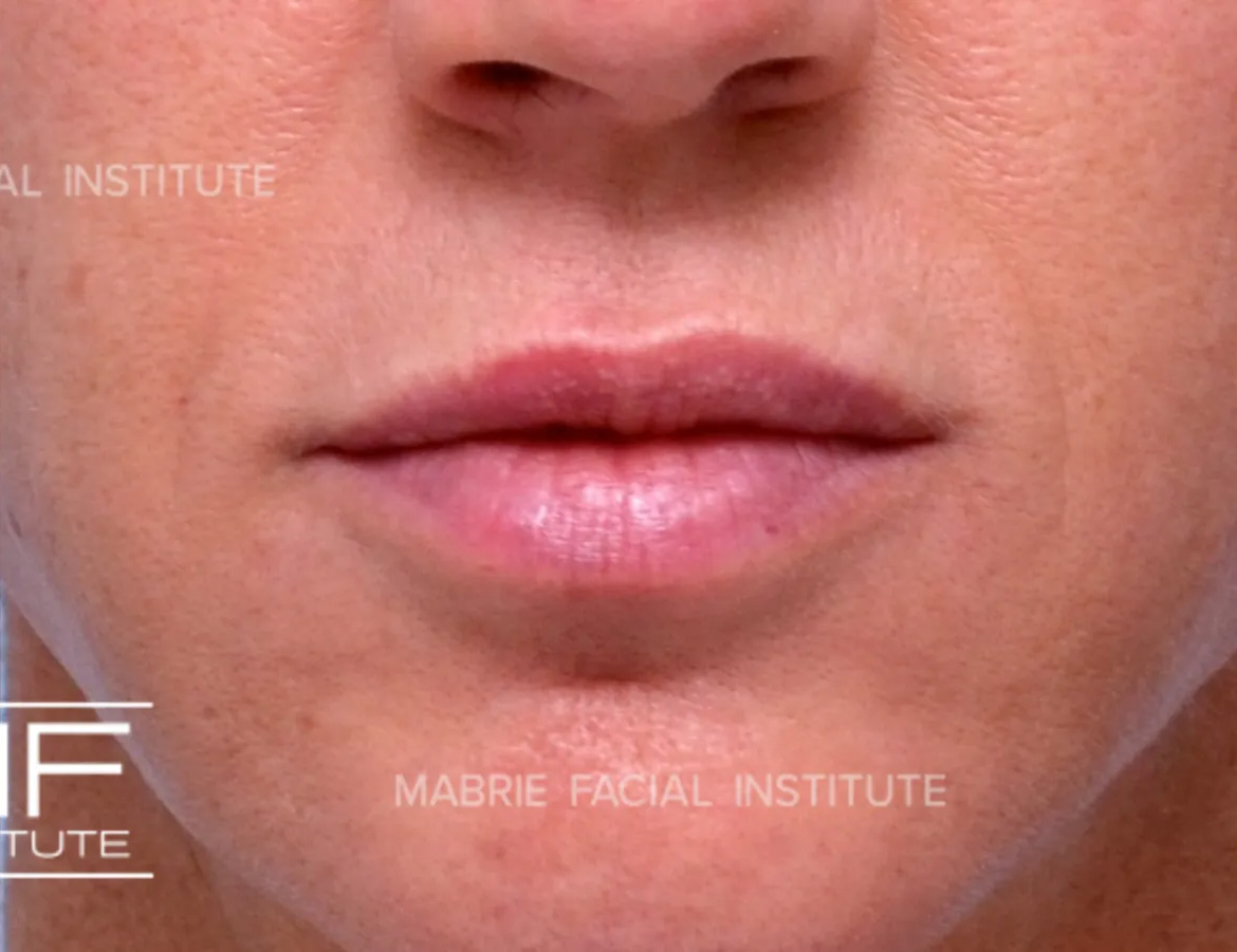 woman after subtle lip filler