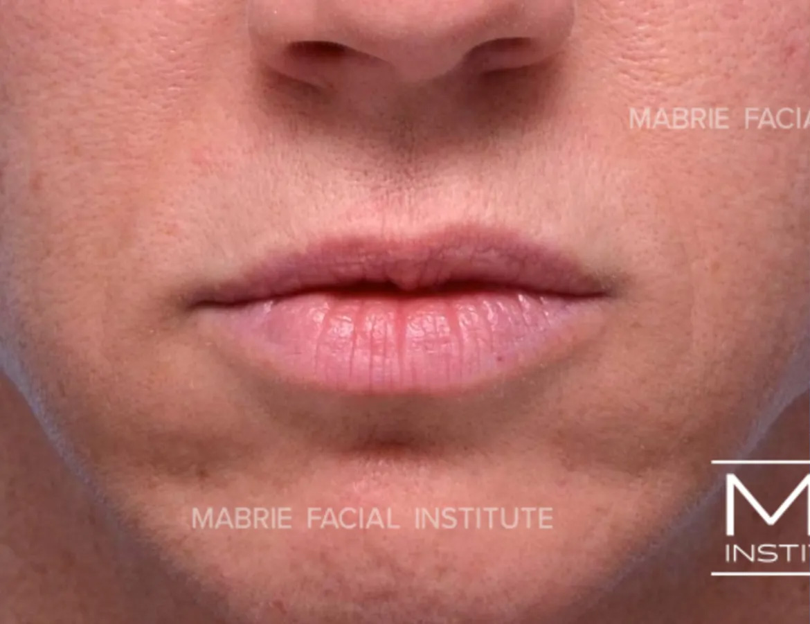 woman before subtle lip filler
