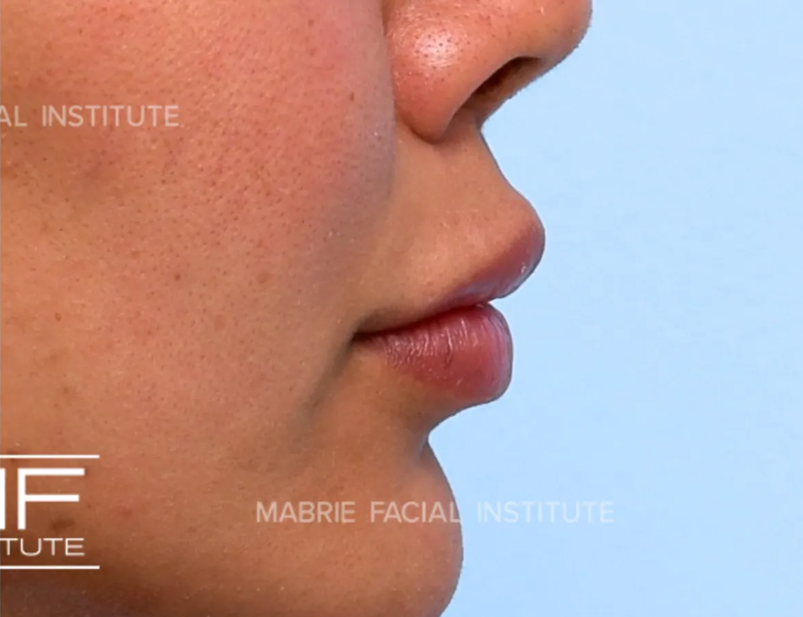 woman after lip filler correction