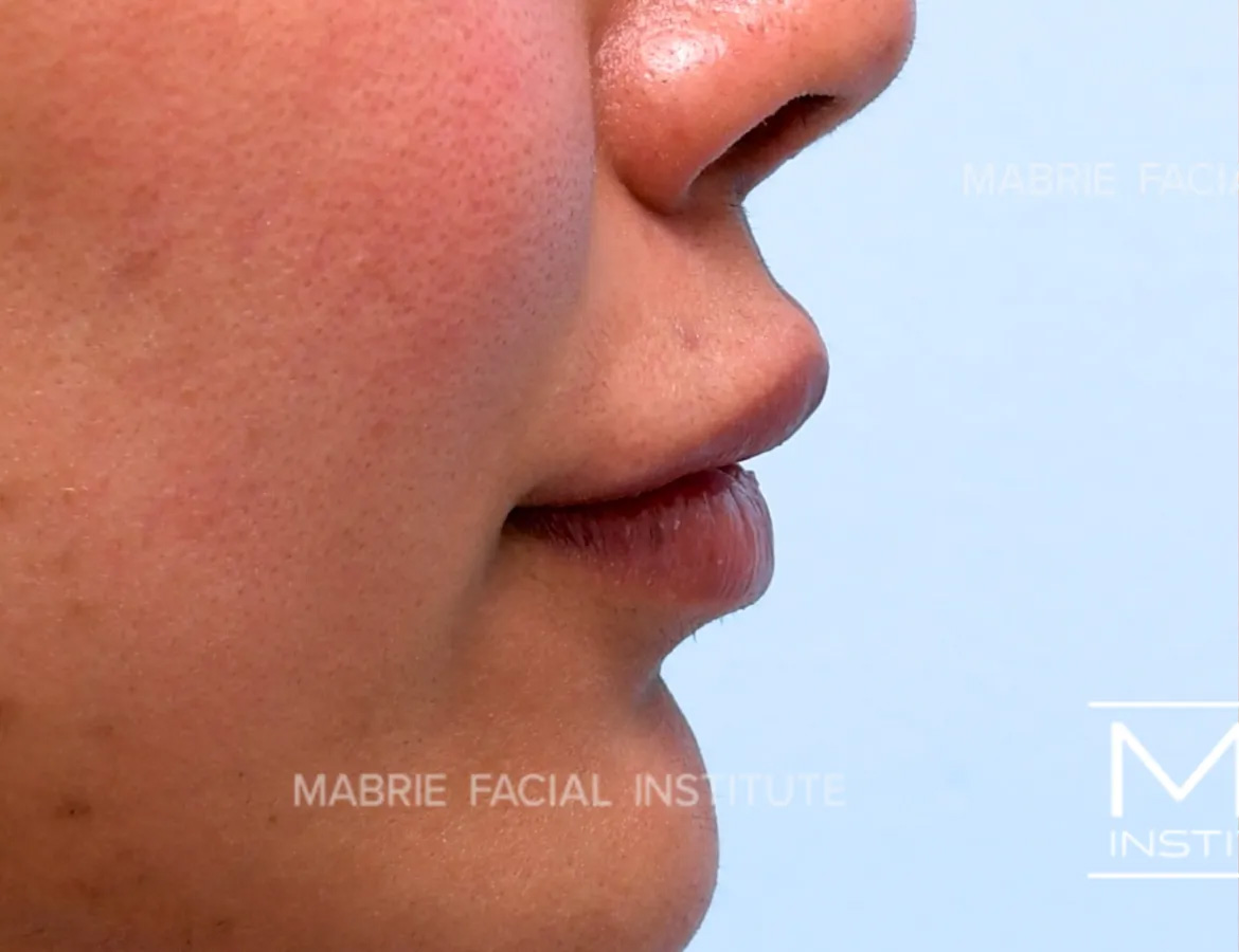 woman before lip filler correction