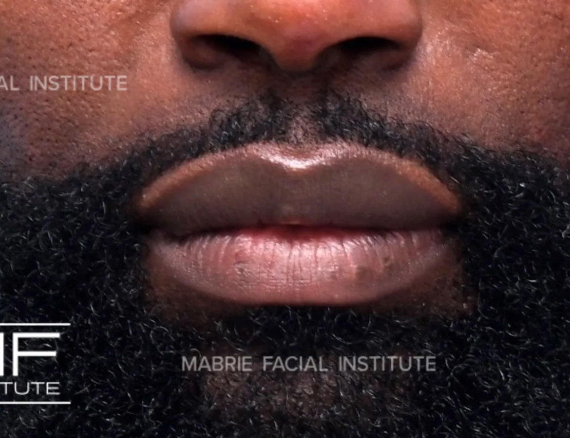 male after lip filler