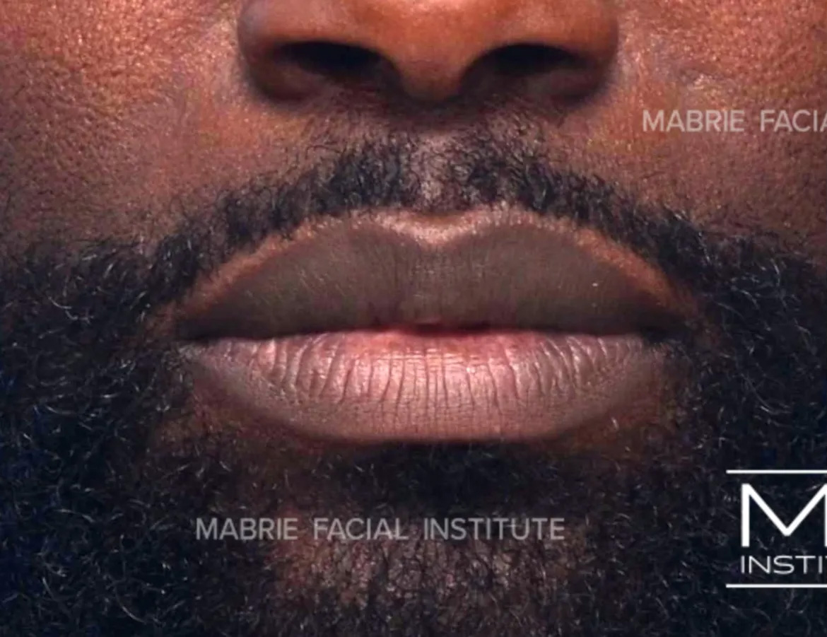 male before lip filler