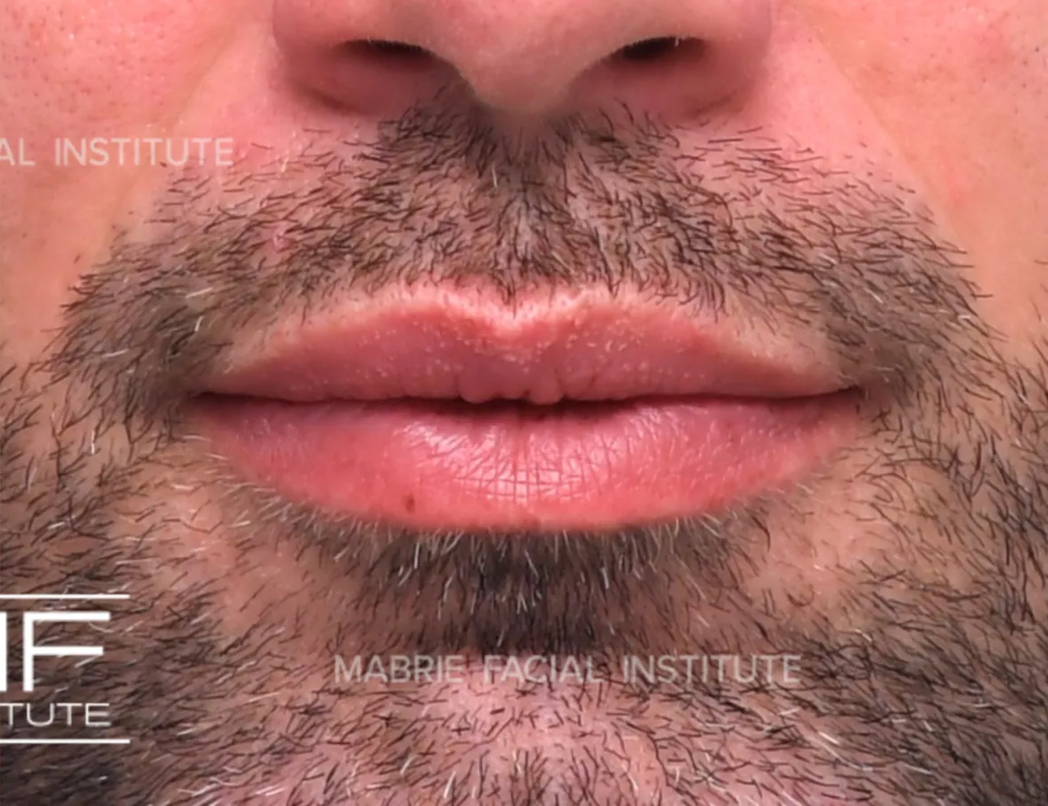 male after lip filler