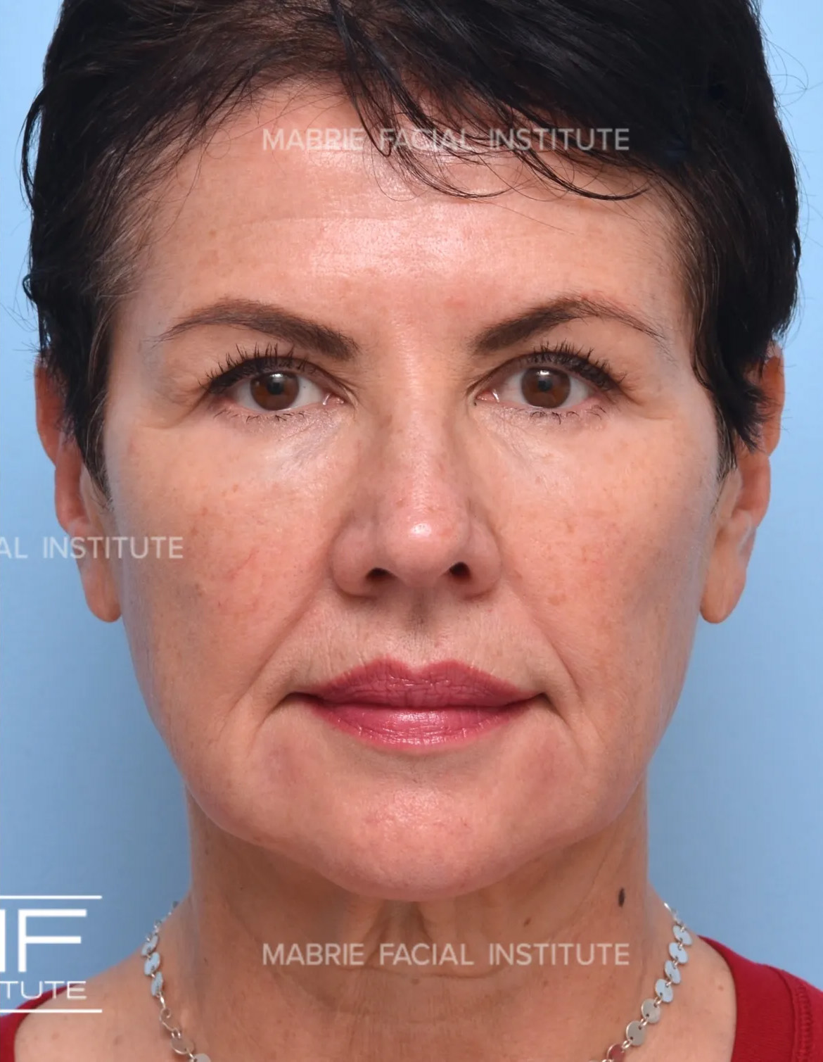 Lower Face Rejuvenation Problem Area - Marionette Lines - After