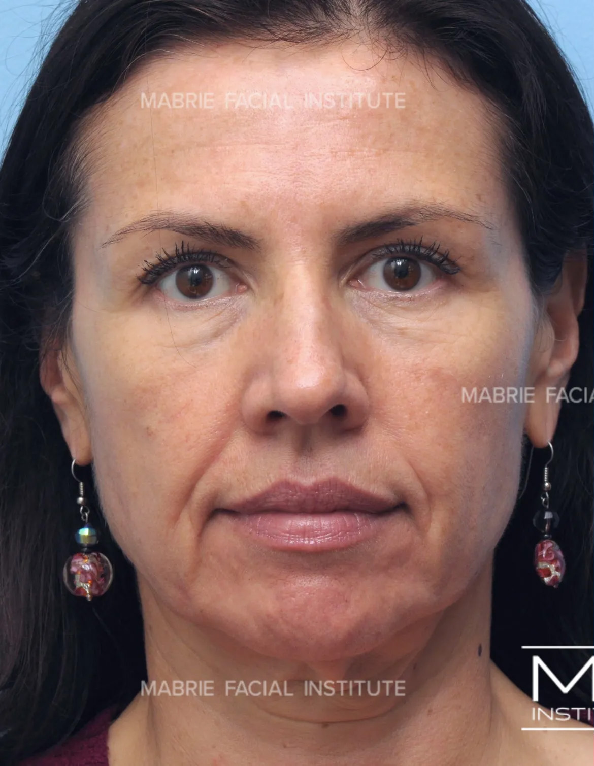 Lower Face Rejuvenation Problem Area - Marionette Lines - Before