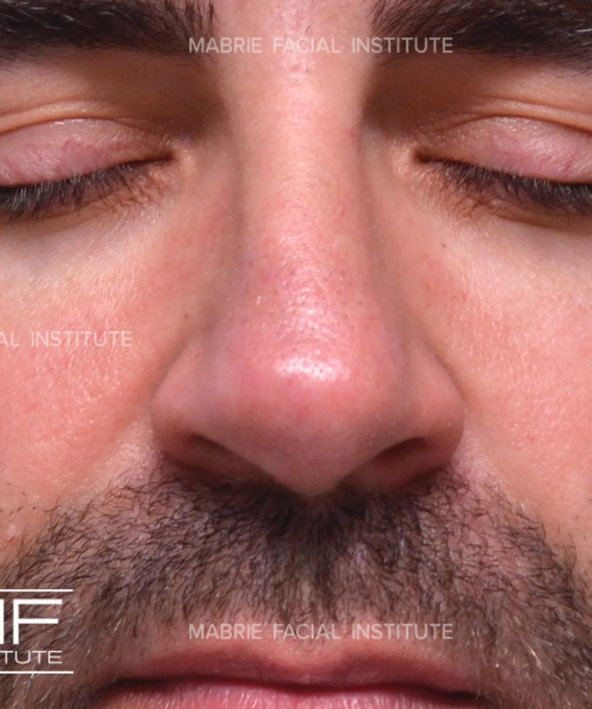 male before nonsurgical rhinoplasty