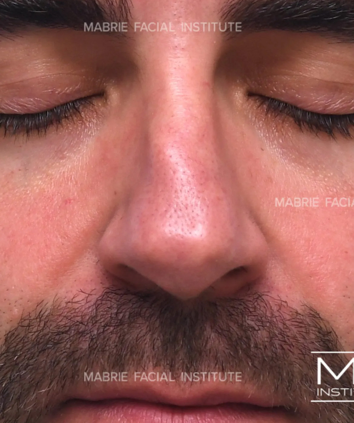 male before nonsurgical rhinoplasty