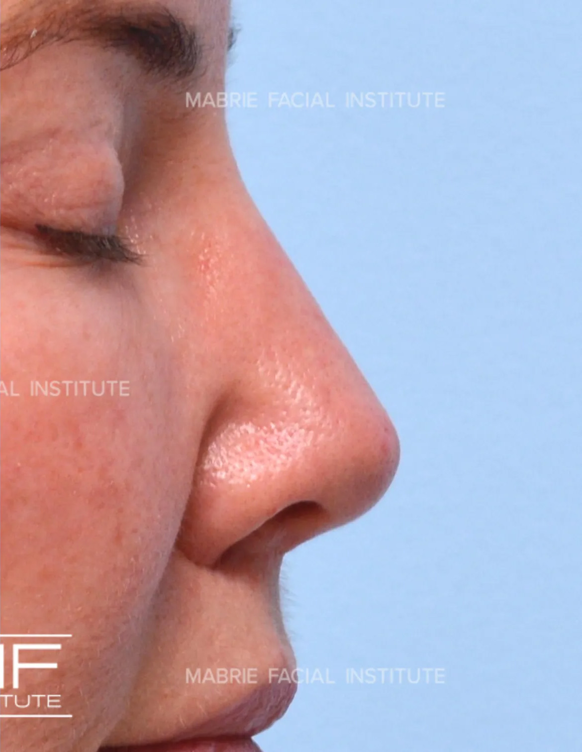 woman after nonsurgical rhinoplasty
