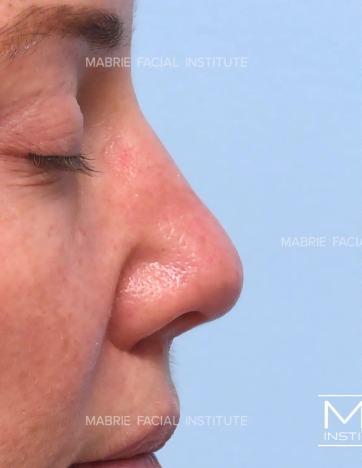 woman before nonsurgical rhinoplasty