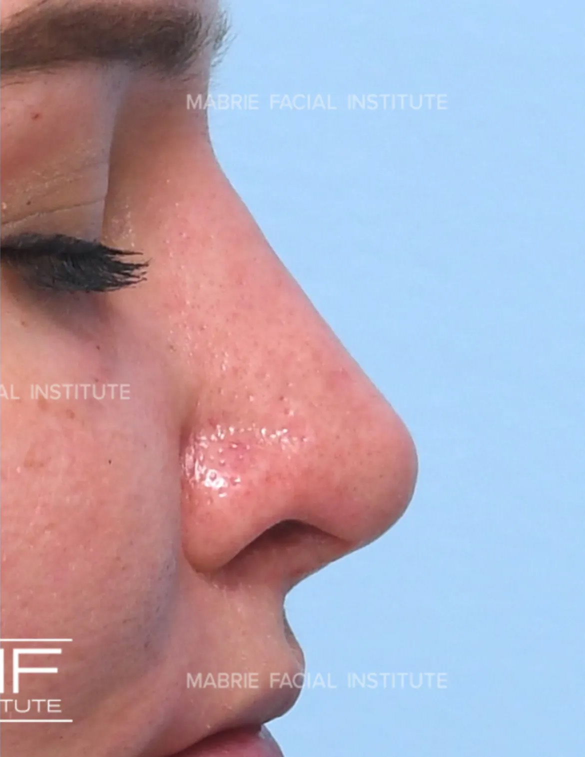 woman after nonsurgical rhinoplasty